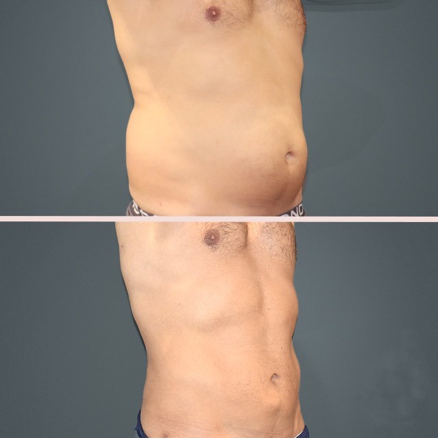 lipo trunk men 2α